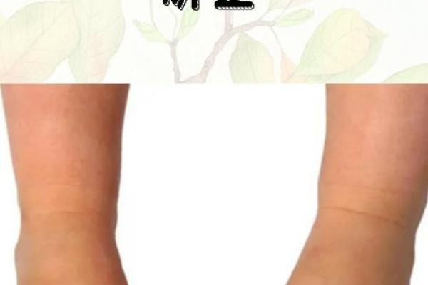 小孩走路内八字