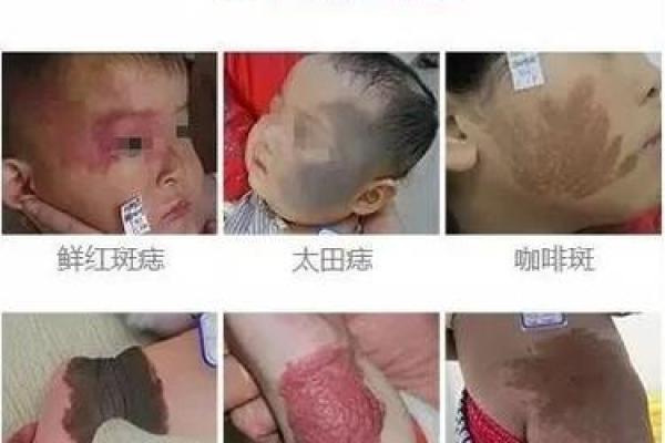 看脸上胎记如何算命