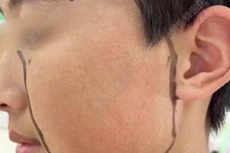 看脸上胎记如何算命