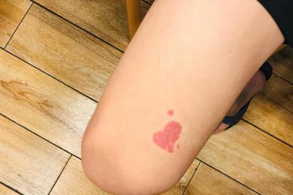 腿上胎记算命分析