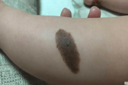 腰部上的胎记如何算命分析？